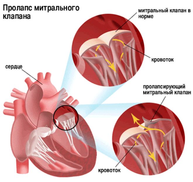 sevastopol i hipertenzija hipertenzija iz gušterače